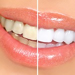 Closeup of a smile that’s half whitened