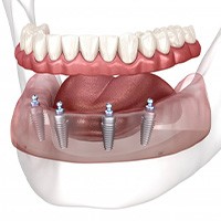 Illustration of all-on-4 dentures