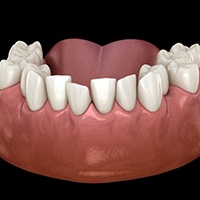 Invisalign patient in Huntington Beach with crowding