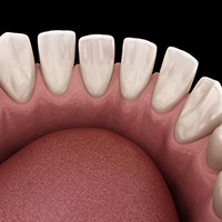 Invisalign patient in Huntington Beach with tooth gaps