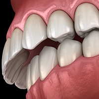 Invisalign patient in Huntington Beach with overbite