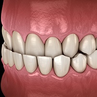 Invisalign patient in Huntington Beach with underbite