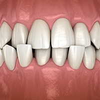 Invisalign patient in Huntington Beach with crossbite