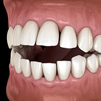 Invisalign patient in Huntington Beach with open bite